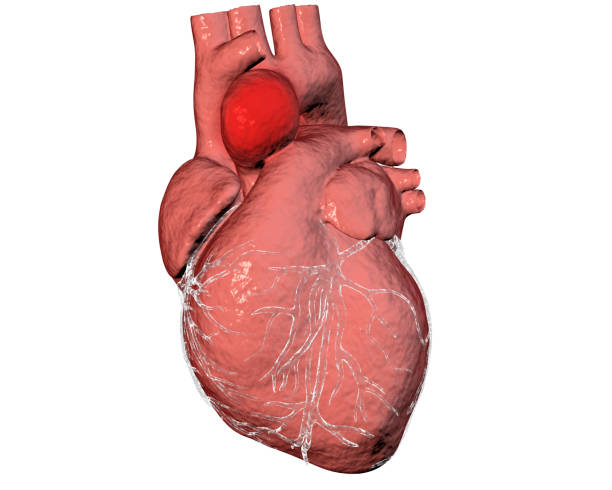 aneurisma dell'aorta ascendente - aorta foto e immagini stock