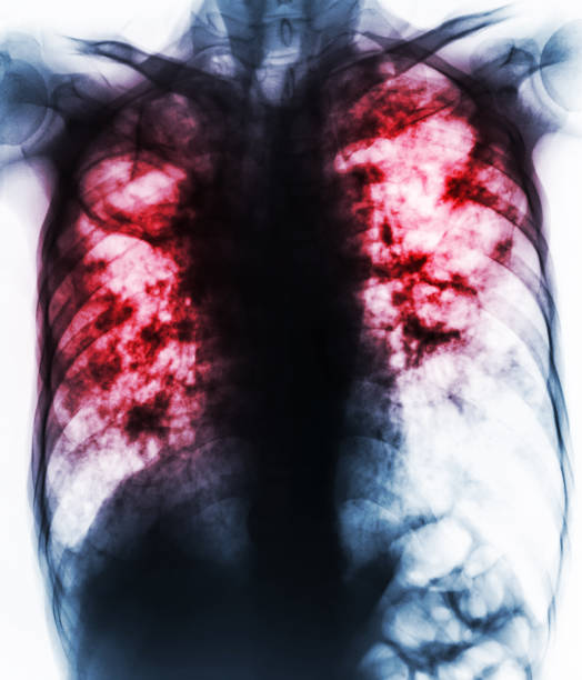 gruźlica płuc . film klatki piersiowej x-ray show zwłóknienie, jamy, śródmiąższowej infiltracji obu płuc z powodu zakażenia mycobacterium tuberculosis . - interstitial zdjęcia i obrazy z banku zdjęć