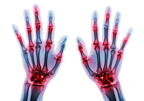 артрит несколько суставов пальцев . рентгеновский снимок пленки обеих рук и запястья. - rheumatic стоковые фото и изображения
