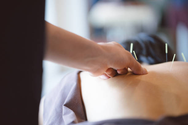 paciente recibe tratamiento de acupuntura - acupuncture needle fotografías e imágenes de stock