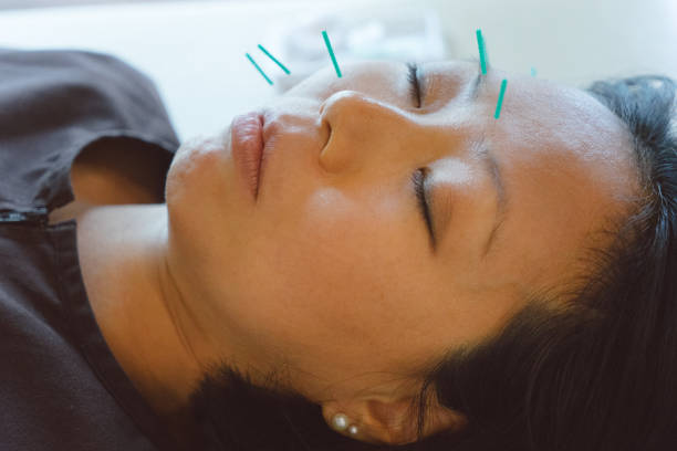 istock Patient receiving acupuncture treatment 810746966
