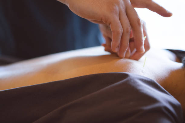 istock Patient receiving acupuncture treatment 810762068