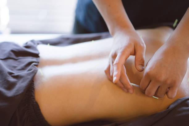 istock Patient receiving acupuncture treatment 810773438
