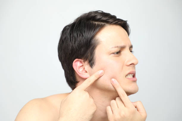 istock young man squeezing a pimple, men's skincare concept 811168750