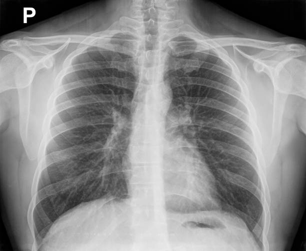 immagine a raggi x del torace che mostra l'anatomia interna della gabbia toracica. - rib cage people x ray image x ray foto e immagini stock