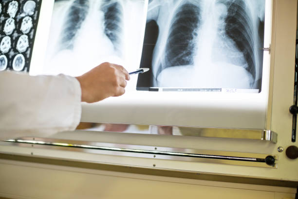 istock Doctor pointing at x-ray image of chest 811280878