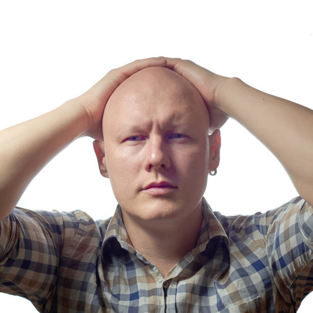 istock Autoimmune total alopecia men portrait. Absolute bald head without eyebrows 812416434