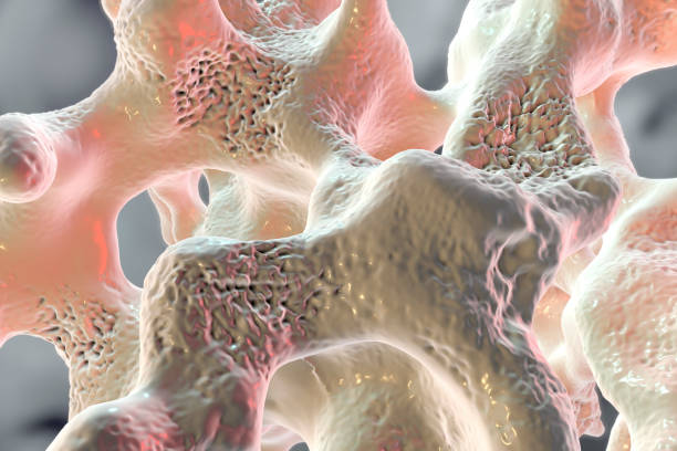 schwammiges knochengewebe von osteoporose betroffen - osteoporose stock-fotos und bilder