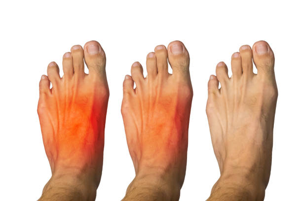 istock man feet with better treatment 812981054