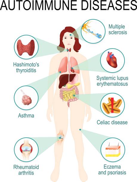 autoimmune diseases. autoimmune diseases. Tissues of the human body affected by autoimmune attack. Disease and organs on silhouette woman. anatomic illustration autoimmune disease stock illustrations