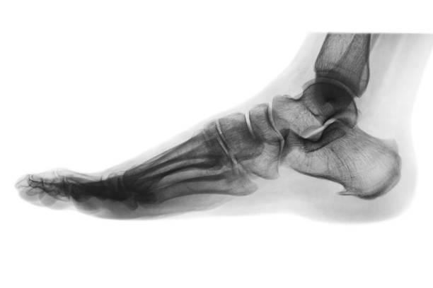 istock X-ray normal human foot . Lateral view . Invert color style . 813062452