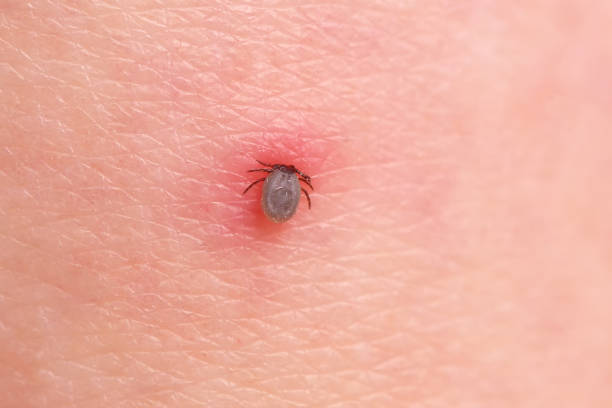 The tick bites the person The tick bites the person, sucked deep under the skin. lyme disease photos stock pictures, royalty-free photos & images