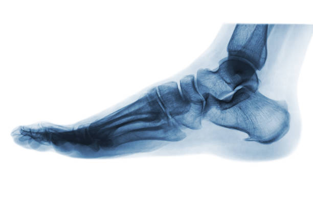 istock X-ray normal human foot . Lateral view . Invert color style . 813840014