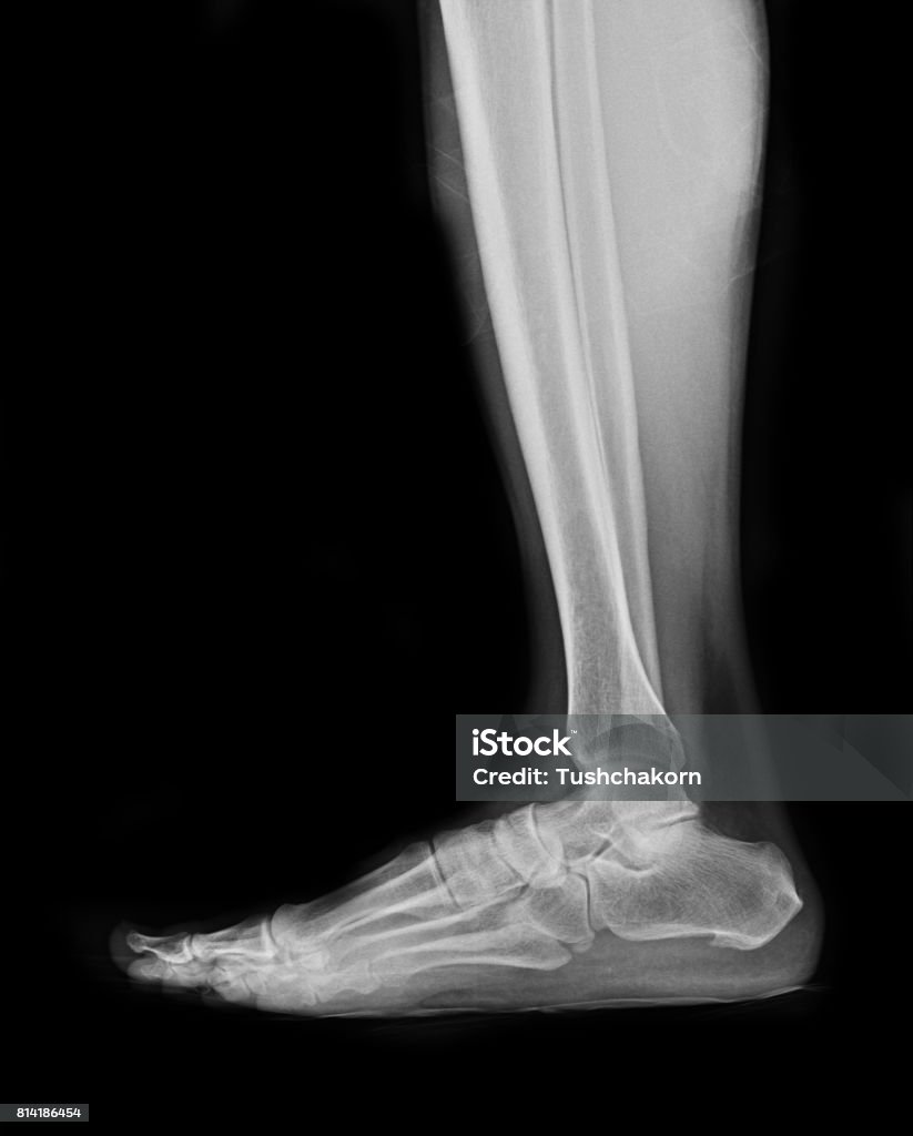 X-rays image of foot fracture patients Foot Stock Photo