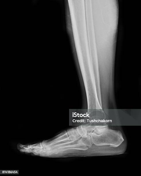 Xrays Image Of Foot Fracture Patients Stock Photo - Download Image Now - Foot, X-ray Image, Leg