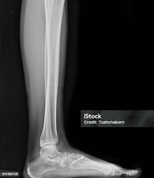 Photo libre de droit de Image De Radiographies Des Patients Fracture Pied banque d'images et plus d'images libres de droit de Adulte - Adulte, Ambulance, Anatomie