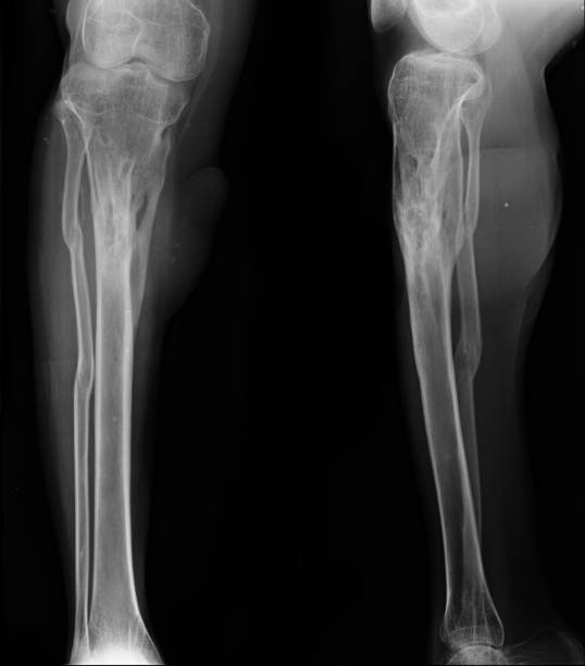 istock X-rays image of leg fracture patients 814188990