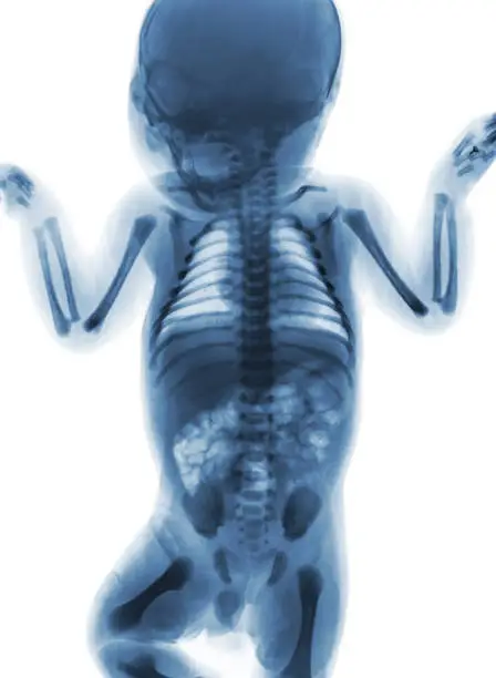 Photo of Film x-ray whole body of normal infant . front view .