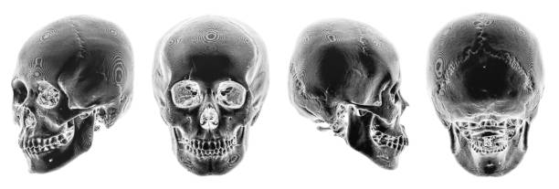 istock 3D CT scan of human skull . Multiple view . Invert color style . 814812472