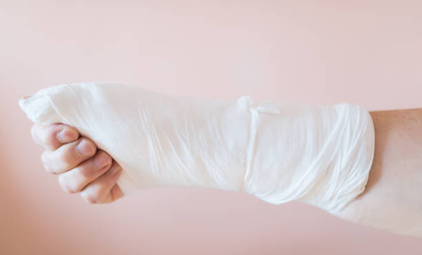 istock Woman with hand in gypsum. 815043128
