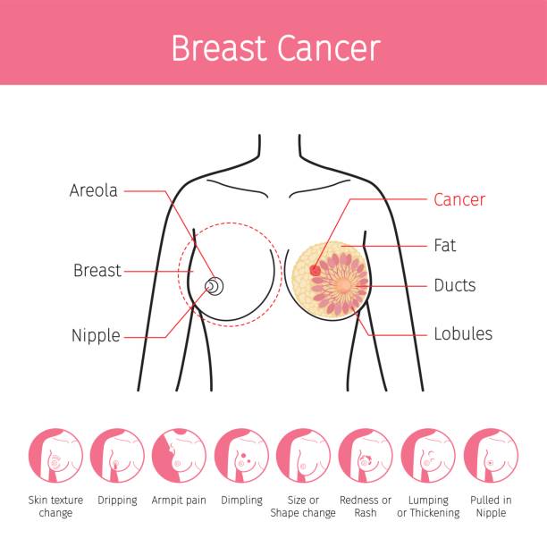 ilustrações, clipart, desenhos animados e ícones de ilustração da mama humana feminina, contorno e ícones de sintoma de câncer de mama - breast cancer