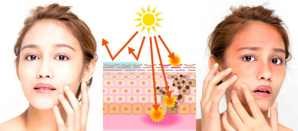 istock woman using sunscreen and woman getting sunburned 815506254