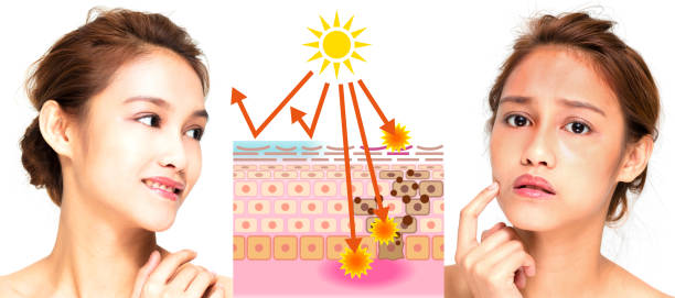 istock woman using sunscreen and woman getting sunburned 815506264