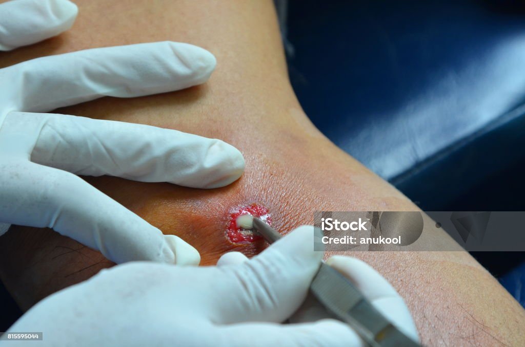 Abscess wound. Nurse was drainage pus abscess. Abscess Stock Photo