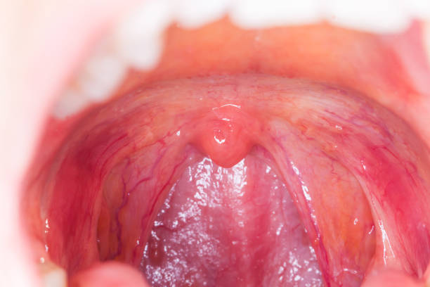 tonsille infezione gola.macro ha aperto bocca gola tonsille - ugola foto e immagini stock