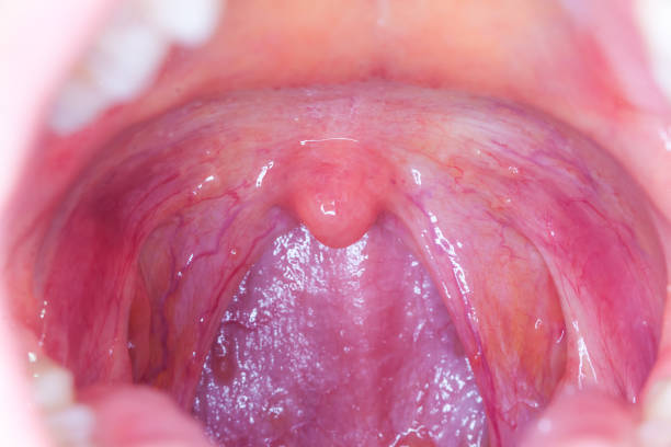 tonsille infezione gola.macro ha aperto bocca gola tonsille - ugola foto e immagini stock