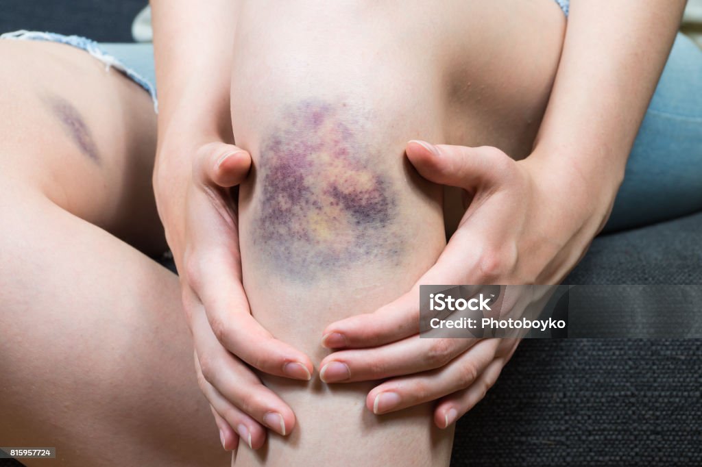 Bruise injury on young woman knee Close up image of female person sitting on sofa and holding in hands wounded leg with hematoma Bruise Stock Photo