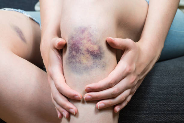 Bruise injury on young woman knee Close up image of female person sitting on sofa and holding in hands wounded leg with hematoma knee contusion bruised knee stock pictures, royalty-free photos & images
