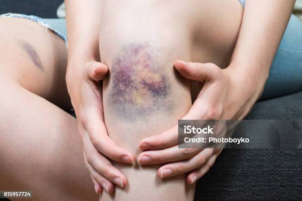 Bruise Injury On Young Woman Knee Stock Photo - Download Image Now - Bruise, Hemorrhage, Knee