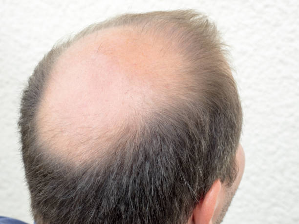 istock Hair loss / Baldness in men 816188486