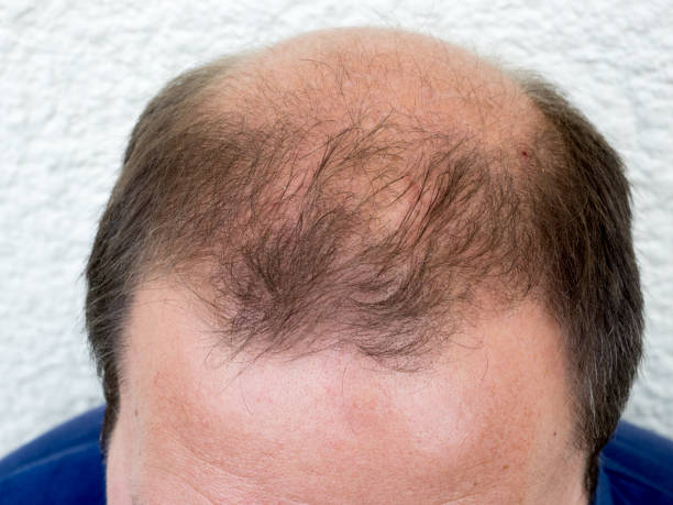 istock Hair loss / Baldness in men 816188566