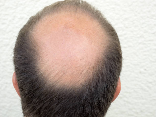 istock Hair loss / Baldness in men 816188602