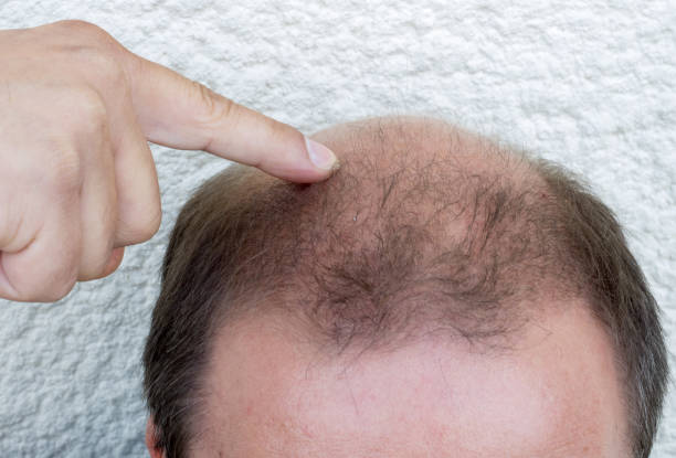 istock Hair loss / Baldness in men 816188612