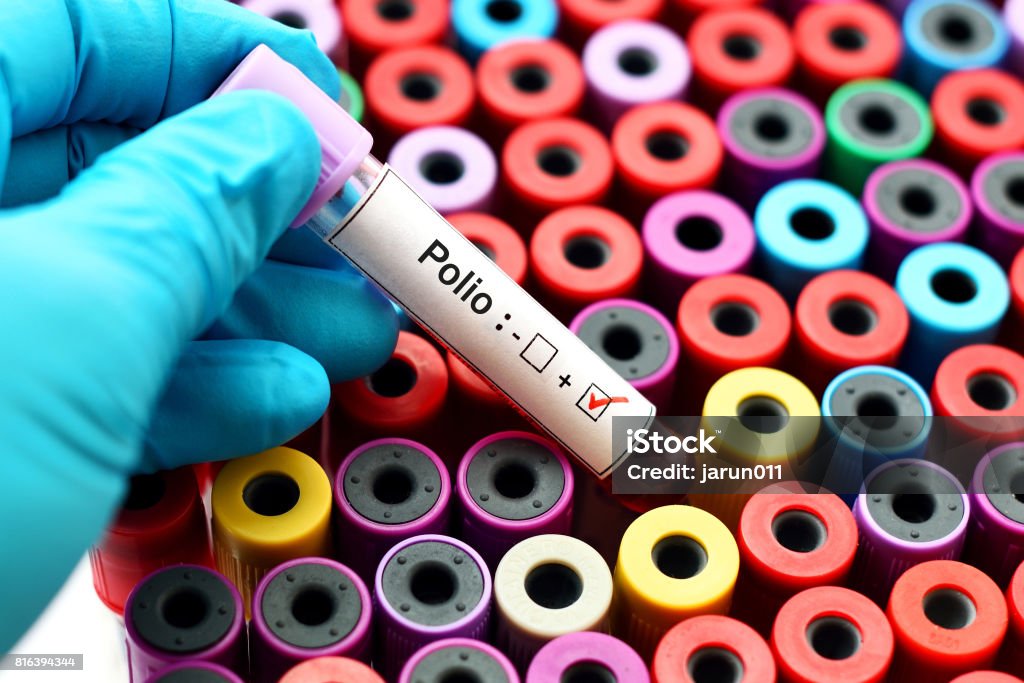 Polio positive Blood sample positive with polio virus Laboratory Stock Photo