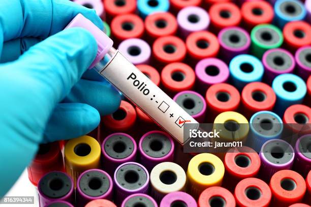 Polio Positive Stock Photo - Download Image Now - Polio Vaccine, Laboratory, Medical Test