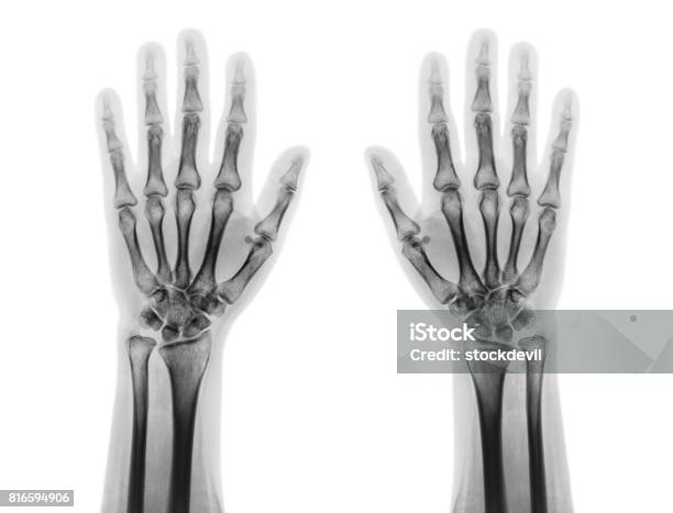 Film Xray Of Both Normal Human Hands Front View Stock Photo - Download Image Now - Hand, Adult, Adults Only