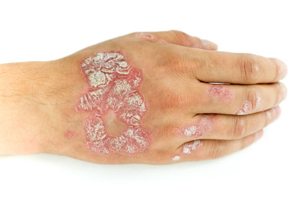 Psoriasis vulgaris and fungus on the man hand and fingers with plaque, rash and patches, isolated on white background. Autoimmune genetic disease. Psoriasis vulgaris and fungus on the man hand and fingers with plaque, rash and patches, isolated on white background. Autoimmune genetic disease. photo psoriasis stock pictures, royalty-free photos & images