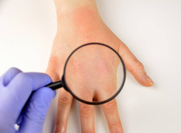 checking the hand Closeup image of doctor checking with magnifying glasses the hand with very dry skin and deep cracks . crevice photos stock pictures, royalty-free photos & images