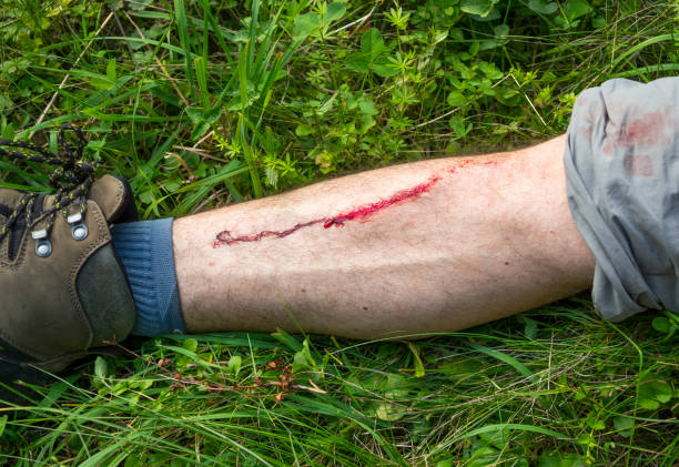 istock Hiking Leg Injury 816978884