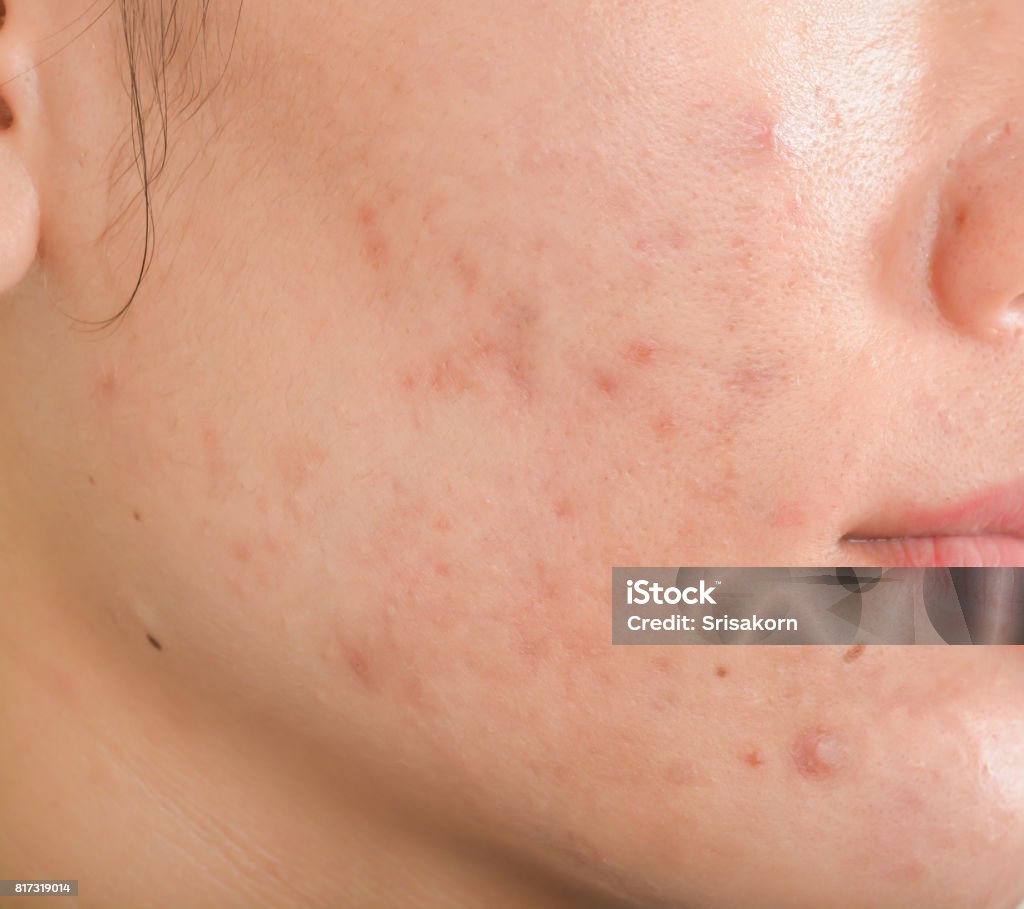 Cicatriz de Acne no rosto - Foto de stock de Pele royalty-free