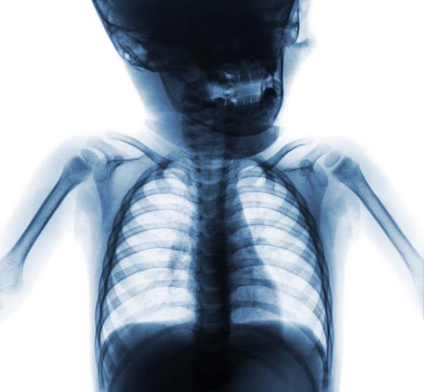 film x-ray normal chest of baby . upper half of body . front view - human upper body xray imagens e fotografias de stock