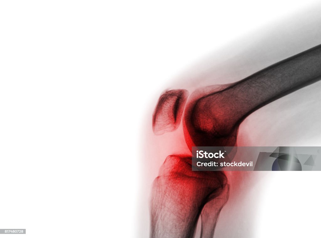 Film x-ray knee joint with arthritis ( Gout , Rheumatoid arthritis , Septic arthritis , Osteoarthritis knee ) Film x-ray knee joint with arthritis ( Gout , Rheumatoid arthritis , Septic arthritis , Osteoarthritis knee ) and blank area at left side Knee Stock Photo
