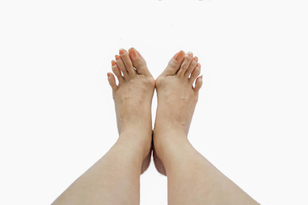 istock Hallux valgus, bunion in foot 818259228