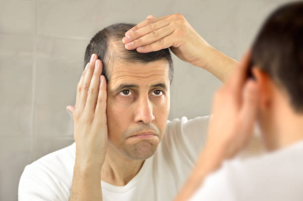 Hair loss man controls hair loss and unhappy gazing at you in the mirror mediterranean ethnicity stock pictures, royalty-free photos & images