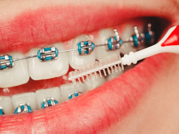 istock Woman smiling cleaning teeth with braces 820512216