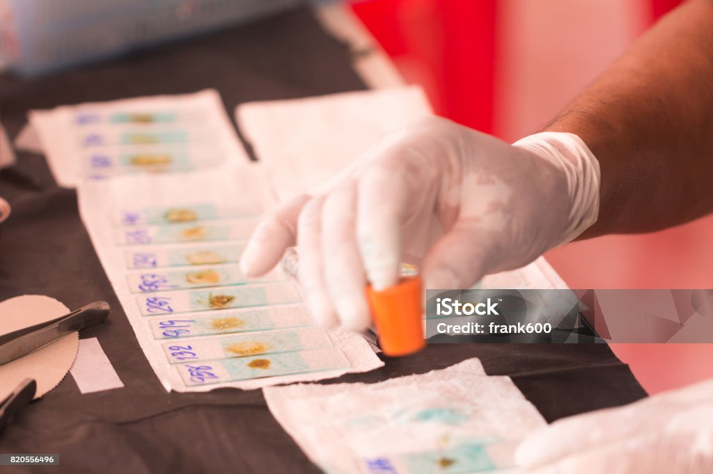 Hand of doctor smear stool exam Hand of doctor smear stool exam for test find fluke’s eggs,Opisthorchis viverrini Epidemiology Stock Photo